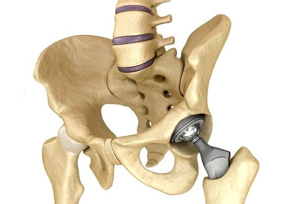 Hip junturaren endoprotetikoak