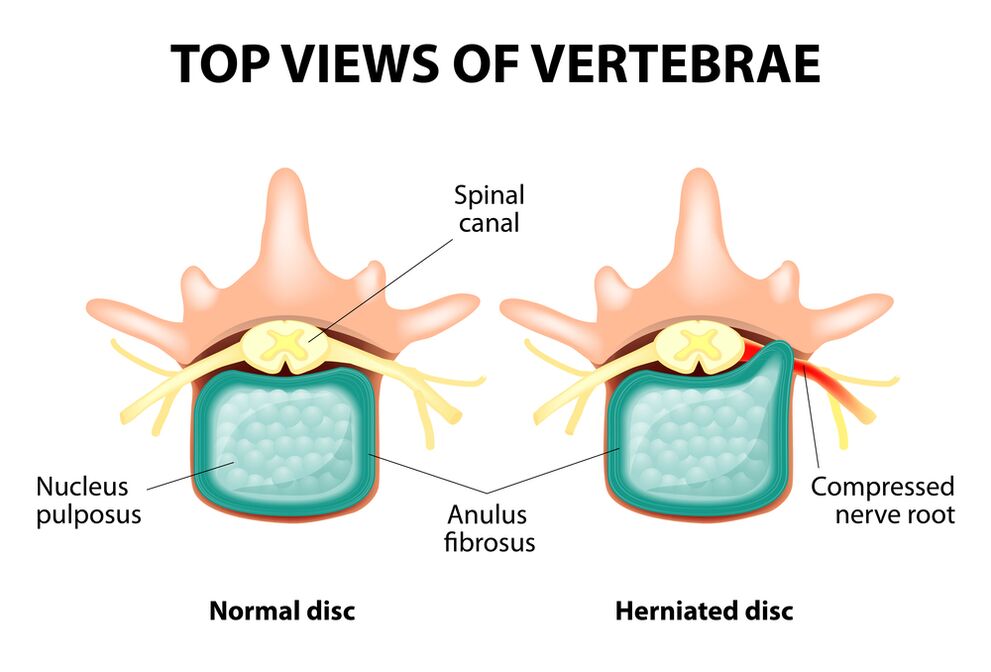 Disko intervertebral osasuntsua eta hernia