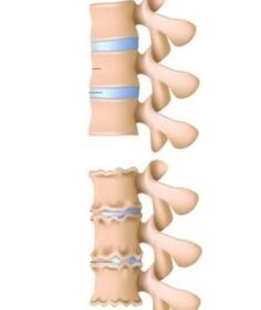 Osteokondrosiaren kausak