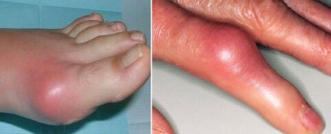 artikulazioen agerpena artritisarekin