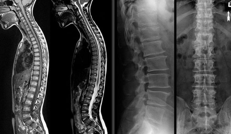 X izpien eta MRI irudiak osteokondrosirako