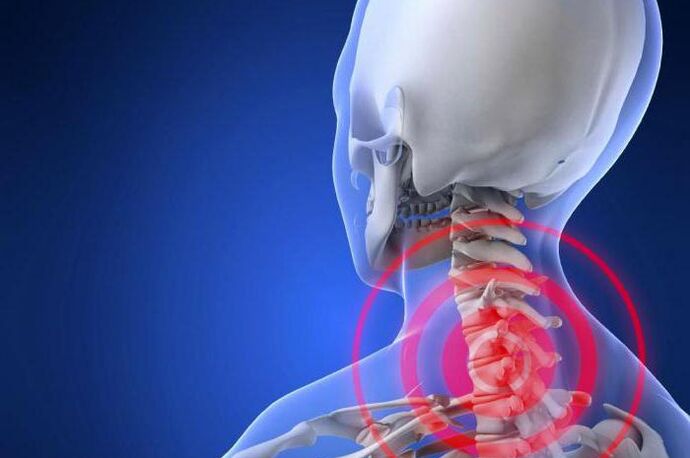 Tiro-mina lepoan - zerbikal-osteokondrosiaren sintoma goiztiarra