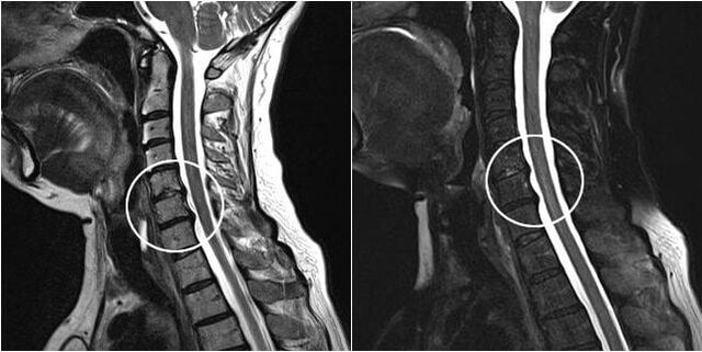 Trápaga bizkarrezurraren MRI osteokondrosiaren zantzuekin