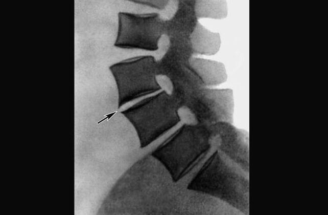 Bizkarrezurreko torazikoaren osteokondrosiaren agerpenak erradiografian