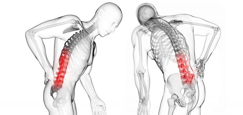 Trápaga osteokondrosiaren konplikazioak